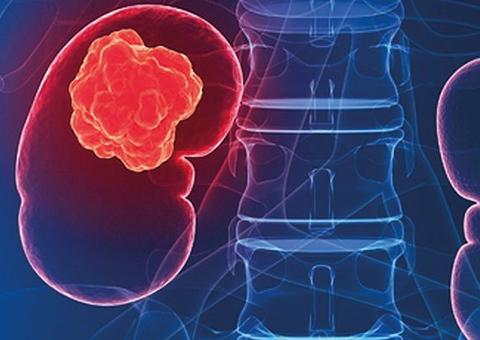 Sintomas não evidentes aumentam taxa de mortalidade por câncer renal
