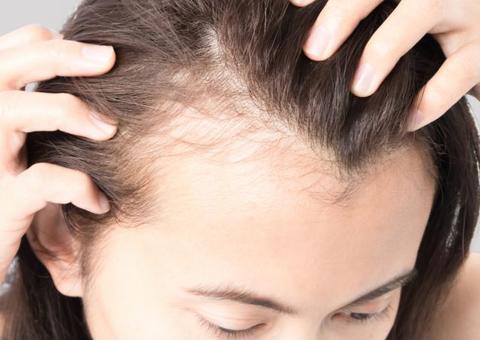 Mitos e verdades sobre a queda de cabelo e calvice precoce 