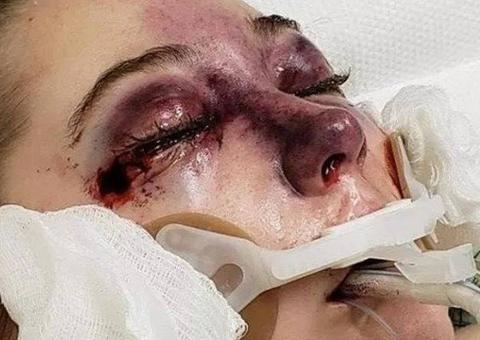 Jovem 'chora sangue' após contrair doença misteriosa durante viagem