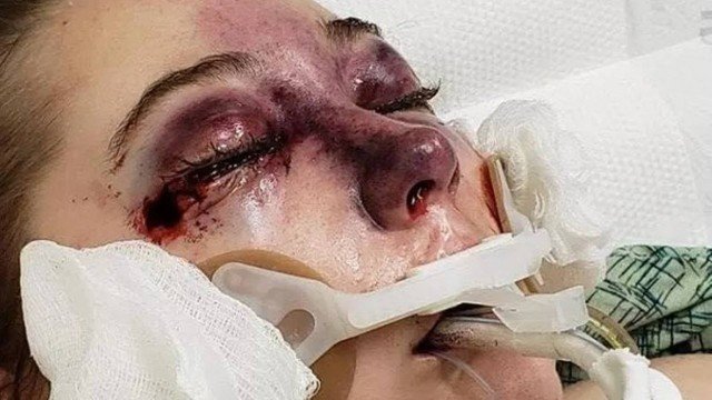 Jovem 'chora sangue' após contrair doença misteriosa durante viagem