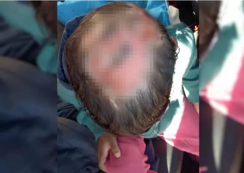 Menino de 4 anos é encontrado com ferimentos e diz à PM que pai queimou a cabeça dele com ferro