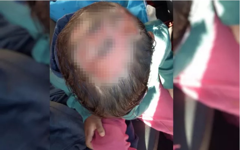 Menino de 4 anos é encontrado com ferimentos e diz à PM que pai queimou a cabeça dele com ferro