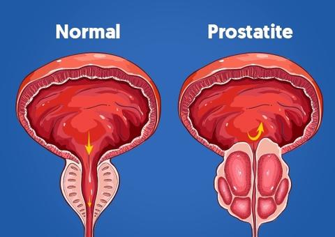 Inflamação da próstata, prostatite afeta também indivíduos jovens