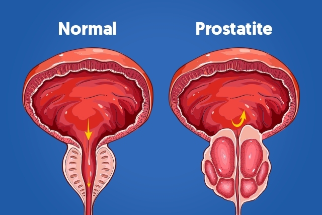 Inflamação da próstata, prostatite afeta também indivíduos jovens