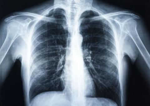 Pneumonia em crianças: 10 coisas que os pais precisam saber sobre a doença