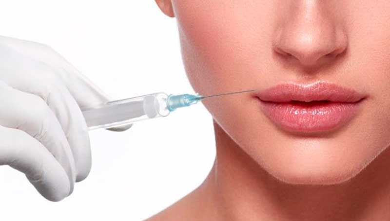 Mitos e verdades sobre o preenchimento labial