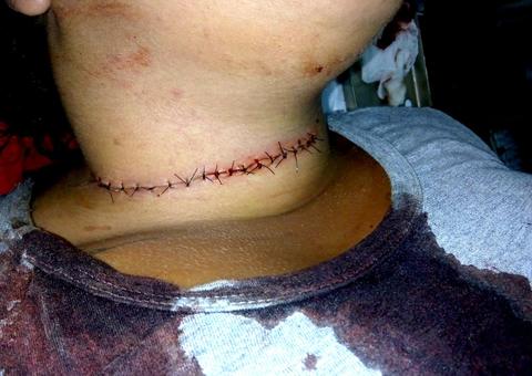 Motociclista leva 19 pontos no pescoço após ser atingida por linha de cerol