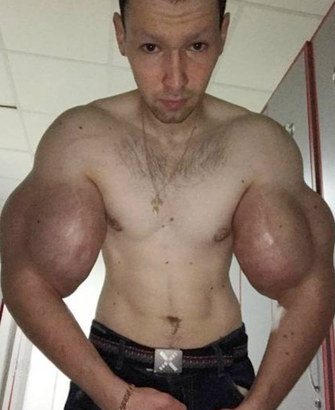 Jovem que injetou óleo no corpo para ter músculos recebe alerta grave de médicos