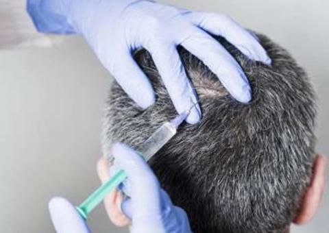 Tratamento pode retardar processo de calvície em homens. Saiba mais