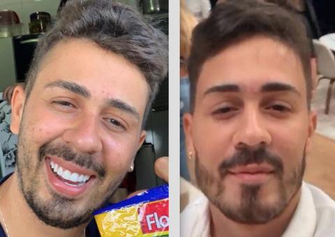 Carlinhos Maia muda formato do rosto com procedimento e resultado chama atenção