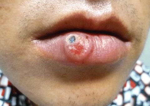 Epidemia Nacional: Especialista alerta para proteção contra Sífilis no Carnaval