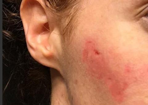 Mulher contrai bactéria após lavar rosto em banheiro público