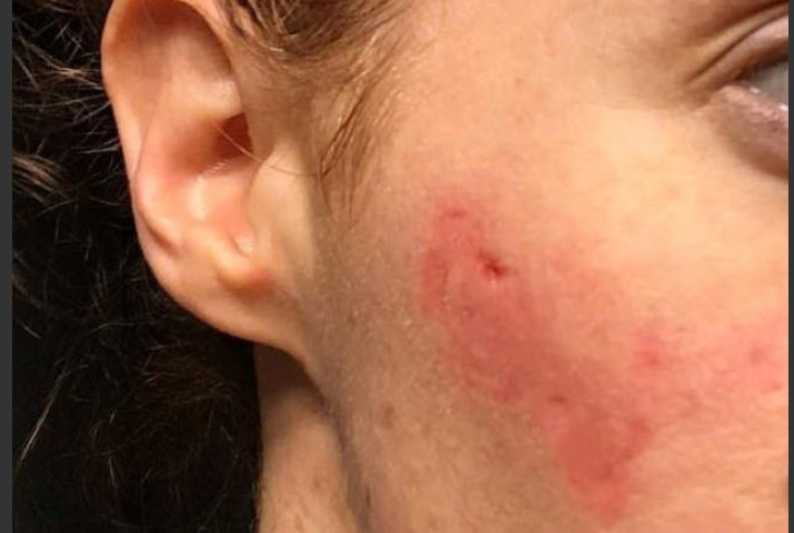 Mulher contrai bactéria após lavar rosto em banheiro público