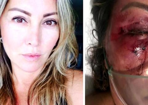  Mulher agredida no Rio tem alta; reconstrução do rosto deve levar 6 meses