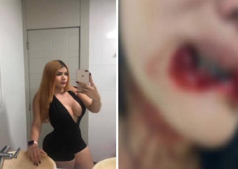 Em Manaus, mulher que teve lábio arrancado faz campanha para pagar cirurgia