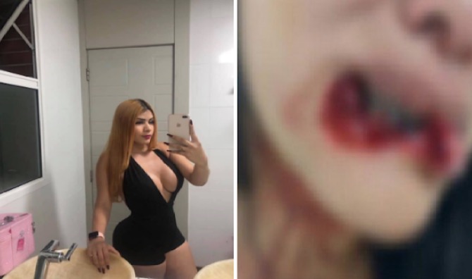 Em Manaus, mulher que teve lábio arrancado faz campanha para pagar cirurgia