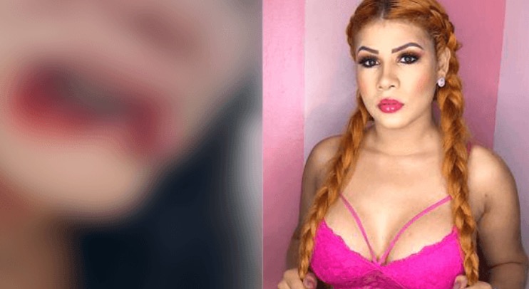 Juíza nega pedido de prisão de blogueira que arrancou lábio de funcionária pública