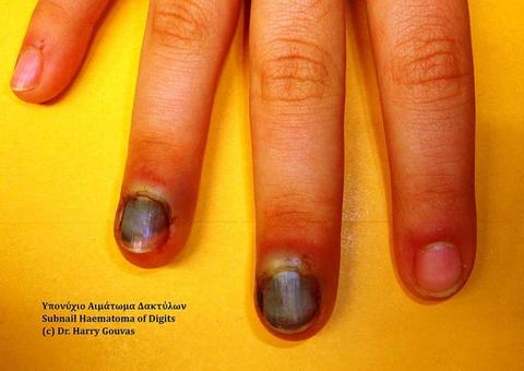 Unhas pretas? Saiba a causa e quando ir ao médico 