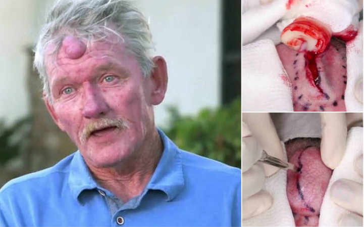 Homem retira 'chifre' durante cirurgia horripilante