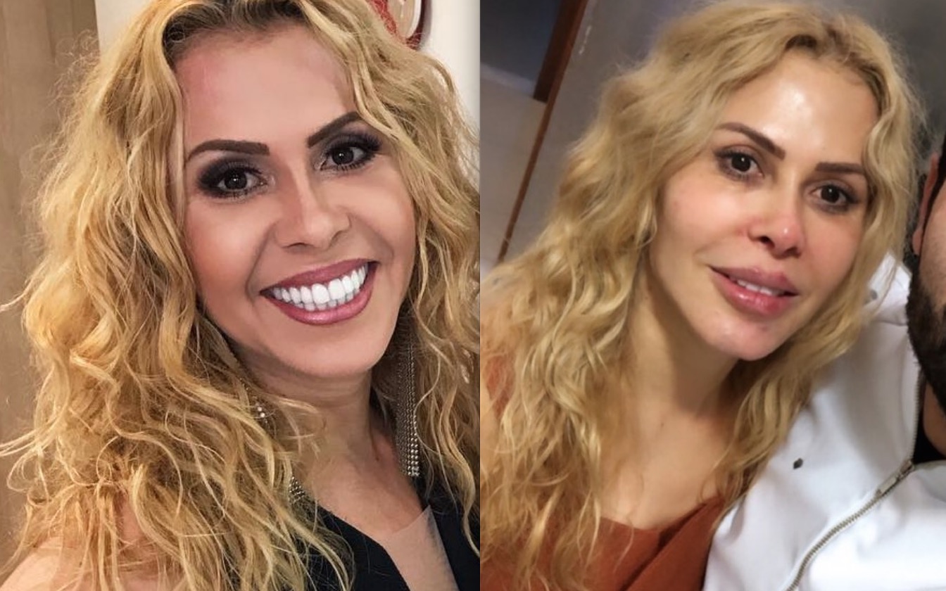 Joelma surge transformada e impressiona após procedimentos estéticos 