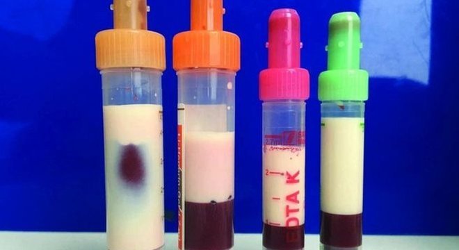 Sangue de homem fica branco de tanta gordura