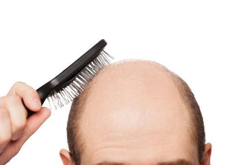 Conheça as principais dúvidas sobre a calvície masculina