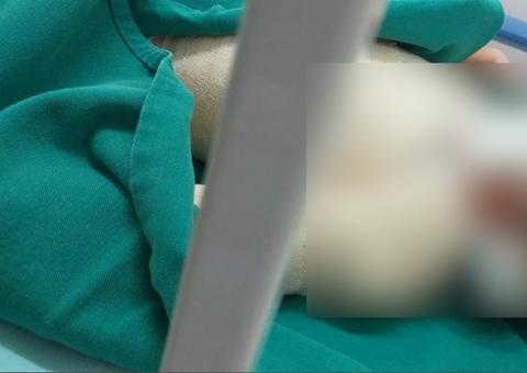 Em Manaus, criança tem quase todo corpo queimado durante aniversário