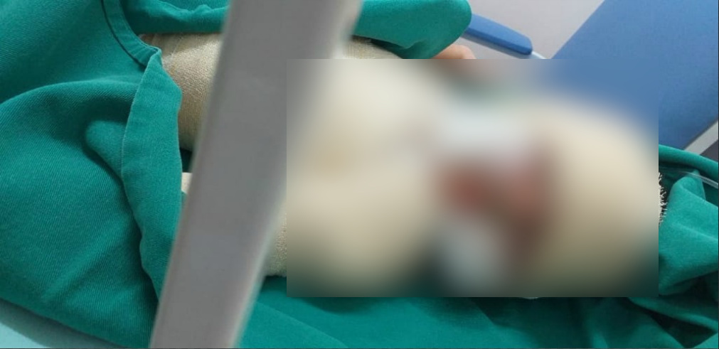 Em Manaus, criança tem quase todo corpo queimado durante aniversário