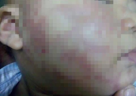 Bebê leva mordidas no rosto em creche, denuncia mãe 