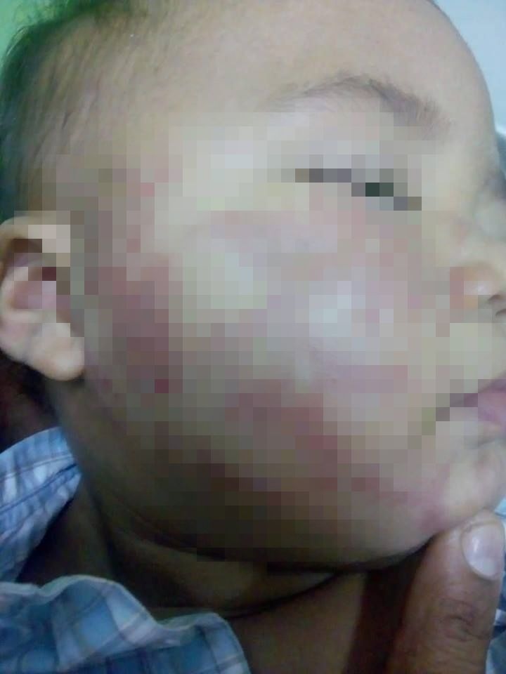 Bebê leva mordidas no rosto em creche, denuncia mãe 