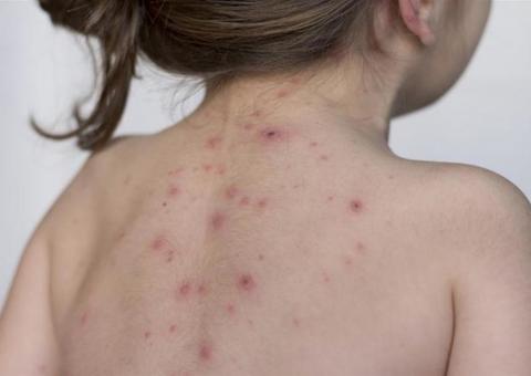 Brasil perderá status de país livre do sarampo após caso endêmico no Pará