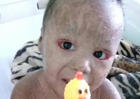 Em Manaus, família pede doações para menino com doença rara 