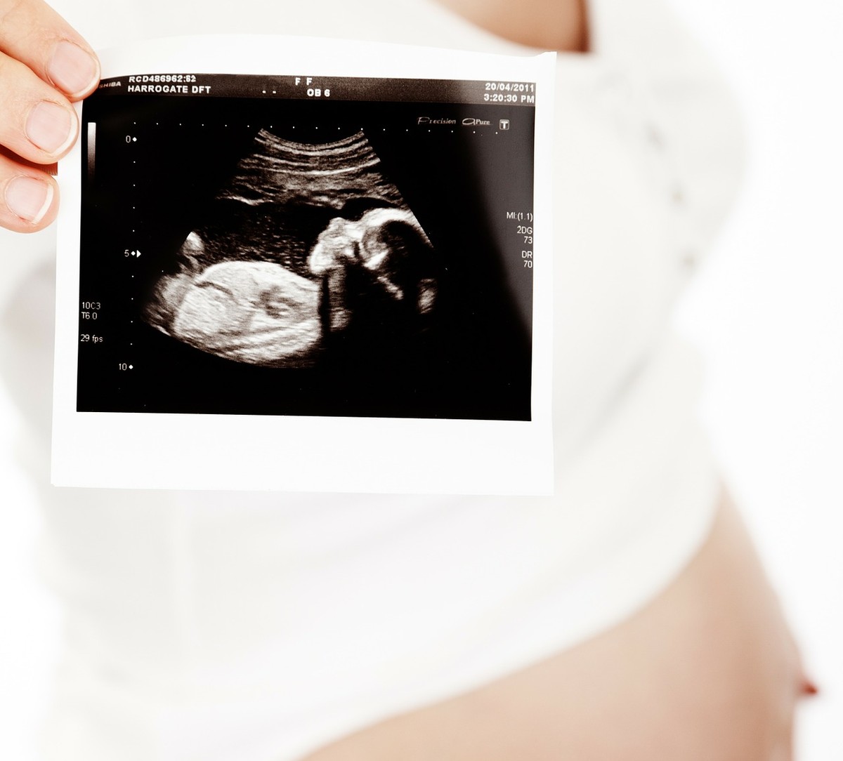 Médico encontra feto dentro de bebê durante exame de ultrassom