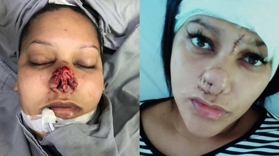 Depois de ter nariz arrancado por ex, mulher terá que passar por 15 cirurgias