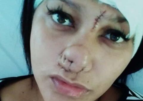 Depois de ter nariz arrancado por ex, mulher terá que passar por 15 cirurgias
