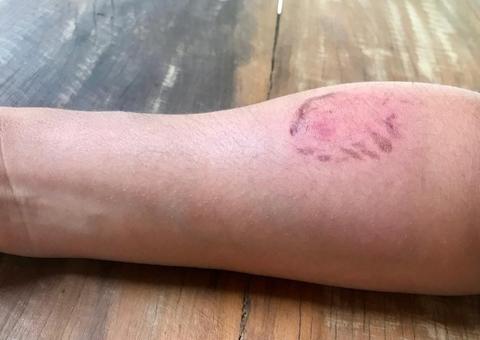 Policial é mordida ao abordar jovem e leva 3 pontos na orelha