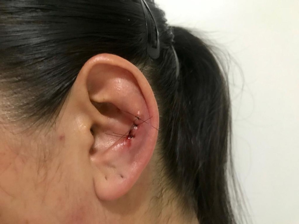 Policial é mordida ao abordar jovem e leva 3 pontos na orelha