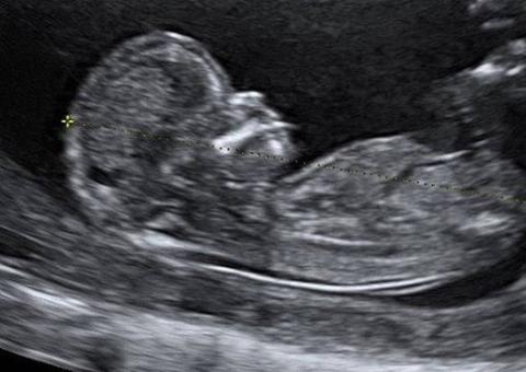 Justin Bieber confunde fãs ao postar foto de ultrassom e dizer que não é 1º de abril