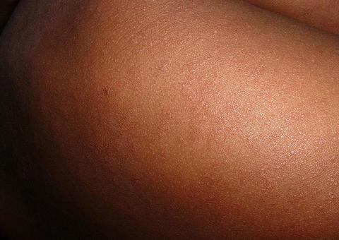 População deve ficar alerta para primeiros sintomas do sarampo  