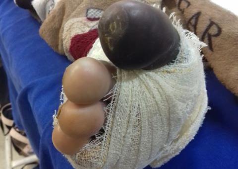 Em Manaus, cirurgias no Hospital 28 de Agosto são adiadas e idoso pode perder o pé