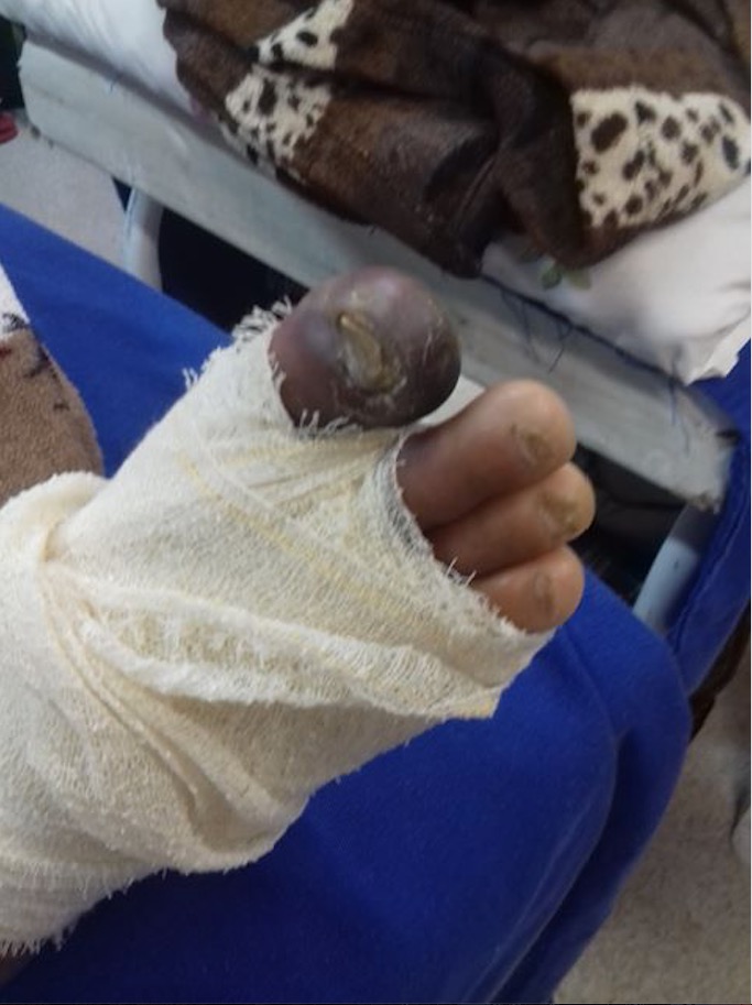 Em Manaus, cirurgias no Hospital 28 de Agosto são adiadas e idoso pode perder o pé