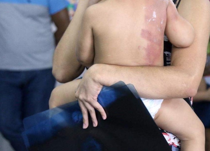 Após acidente doméstico, menino de 4 anos é espancado pelo padrasto em Manaus