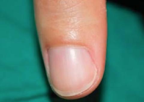 Homem amputa dedo após ter votado errado em eleições