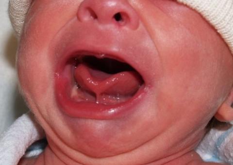 Pediatras pedem fim da obrigatoriedade do Teste da Linguinha