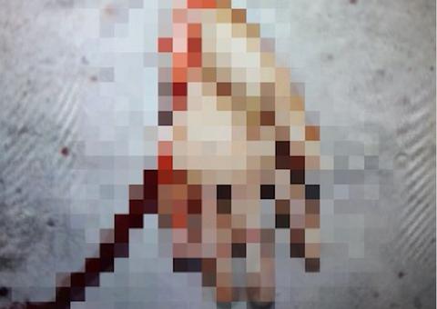 Homem tem a mão decepada durante briga de terçado com vizinho em Manaus 