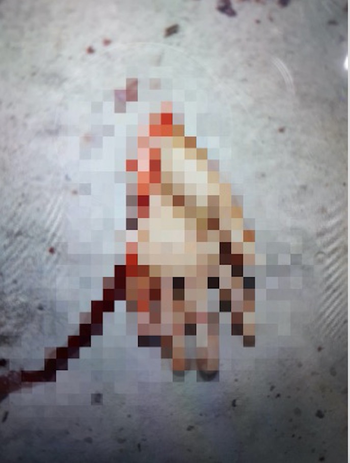 Homem tem a mão decepada durante briga de terçado com vizinho em Manaus 