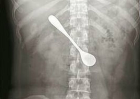 Mulher fica com colher no intestino após engasgar com peixe 