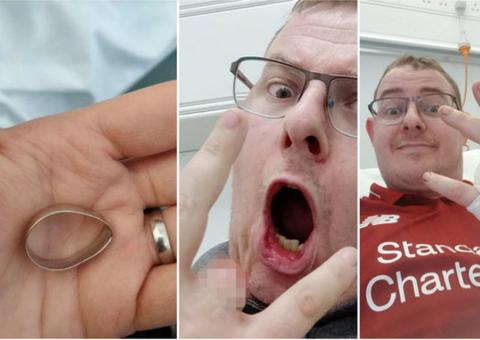 Recém-casado tem dedo arrancado com aliança ao tentar pular cerca