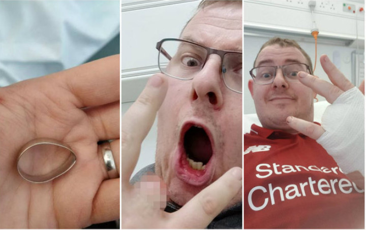 Recém-casado tem dedo arrancado com aliança ao tentar pular cerca