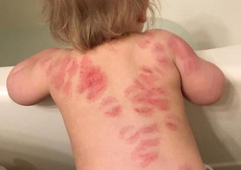 Bebê de 1 ano é mordido mais de 20 vezes em creche